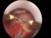 Histeroskopi ile rahim içi perde ( uterin, uterus septum - subseptum ) kesilmesi operasyonu