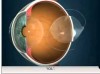Multifocal Intraocular Lens