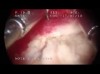 Histeroskopik Polip Ameliyatı
