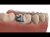 Inlays and onlays - Lapointe dental centres