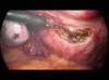Laparoskopik Histerektomi (Kapalı Rahim Alınması) Ameliyatı