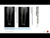 High Tibial Osteotomy ( Open Wedge Technique )