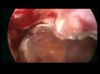 Karın içinde uterus (rahim) çevresi yapışıklık açılması (Adhezyolizis) yöntemi