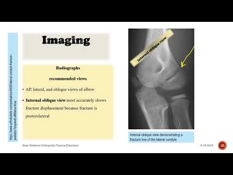 Fracture of Necessity - Lateral Condyle Fracture –In Child