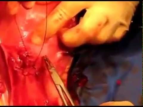 Purse string uterine closure in cesarean section. Turan Technique